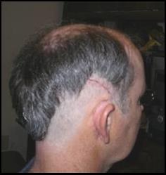 Incision, 5 days after surgery