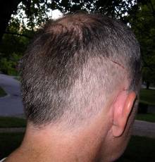 Incision ten days post-op