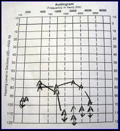 My audiogram, before implant